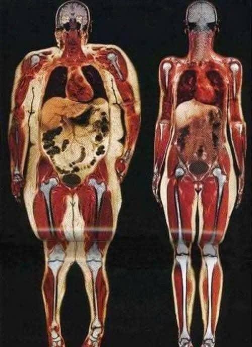SỰ KHÁC BIỆT GIỮA CƠ THỂ THỪA CÂN VÀ CƠ THỂ KHỎE MẠNH QUA QUÉT MRI - HIỂM HỌA TỪ BÊN TRONG